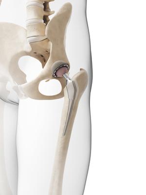 How Long Will My Hip Replacement Last