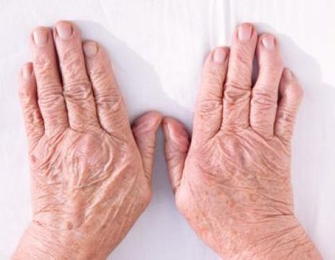 Rheumatoid Arthritis