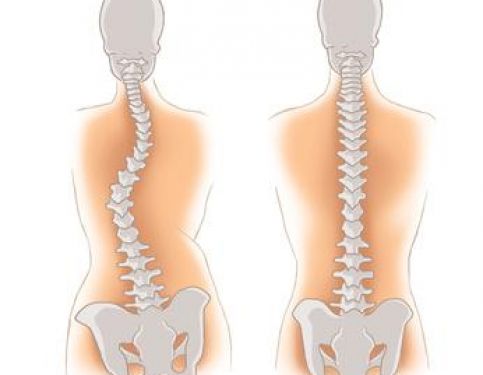 Scoliosis