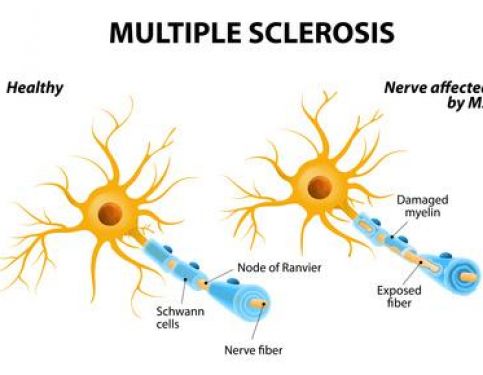 Help for Multiple Sclerosis in Sutton Coldfield