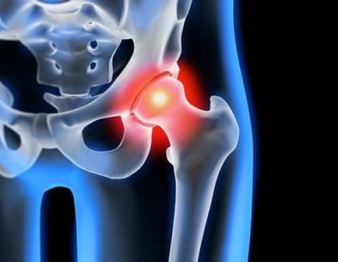 Hip Replacements. Now or Later? When is best?