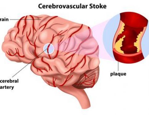 Repetitive Task Training & Stroke