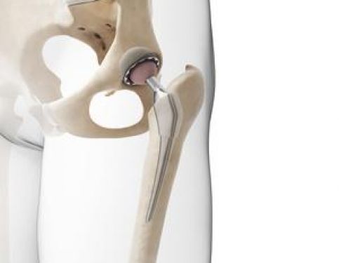 Hip Fractures and Physiotherapy