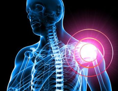 Thoracic Outlet Syndrome