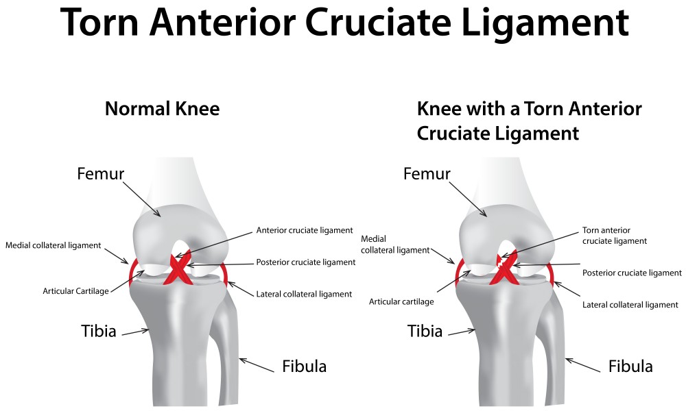 anterior cruciate ligament rupture