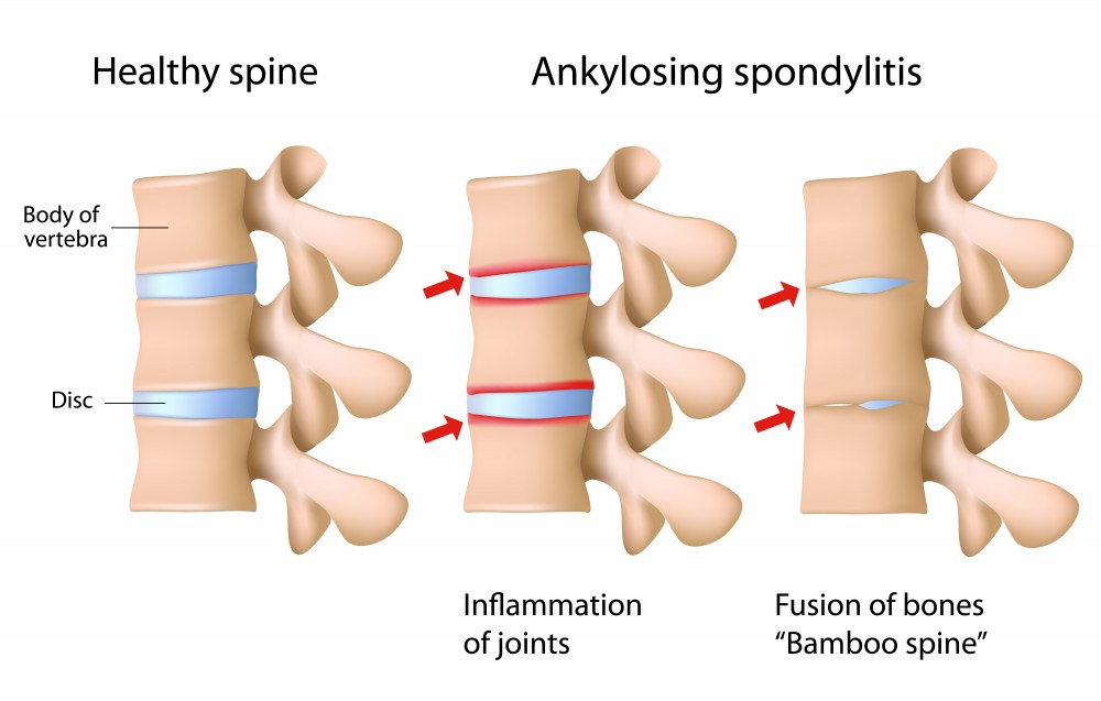 Ankylosing Spondylitis