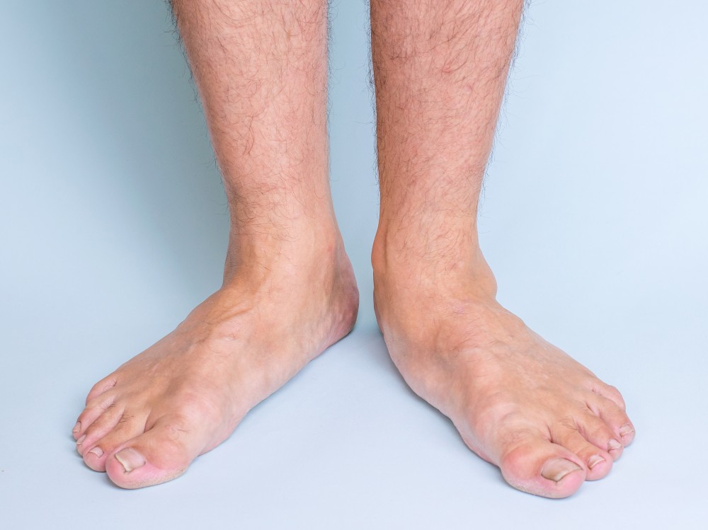 flat feet knee pain