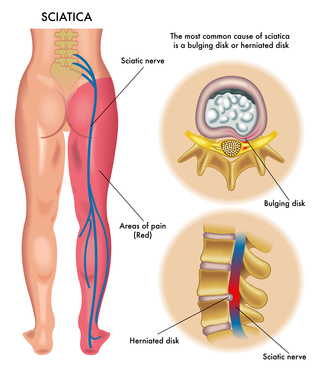 Sciatic Nerve