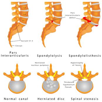 Spondylolisthesis